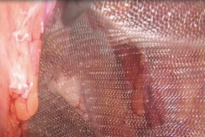 Βουβωνοκήλη Λαπαροσκοπικά με δίχτυ απο τον DR Τσαγκατάκη Θωμά Dr Tsagkatakis Thomas Laparoskopiki epemvash khlhs Hrakleio Kritis